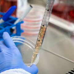 Sanofi, nuovo anticorpo riduce la progressione della sclerosi multipla