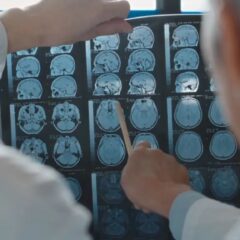 Tumori al cervello, grandi passi avanti nella neurochirurgia